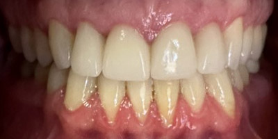 Close-up of a person's upper and lower teeth showing slight yellowing and visible gums.