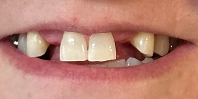 Close-up of a person's mouth with upper teeth showing gaps and one missing tooth.