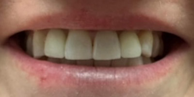 A close-up of a person's mouth, slightly smiling, showing upper and lower teeth. Lips appear dry and slightly chapped.