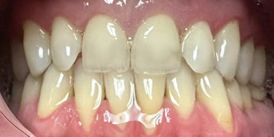 Close-up of a person's mouth showing upper and lower teeth with noticeable dental crowding and gingival tissue visible.