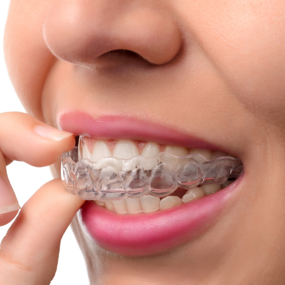 Woman wearing orthodontic silicone trainer. Invisible braces